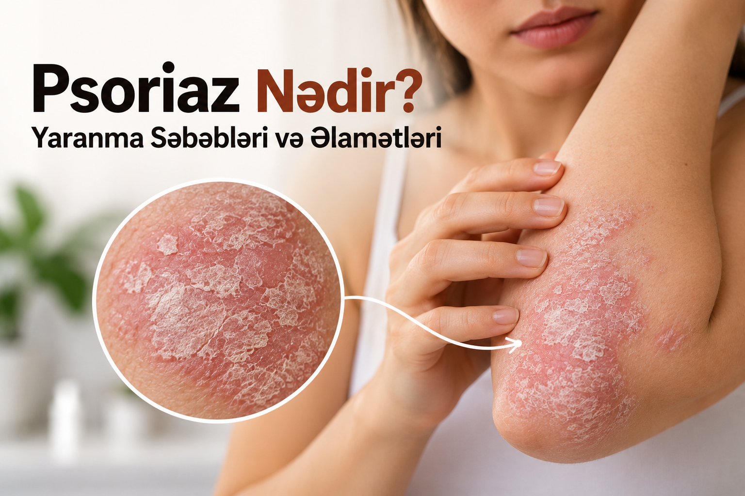 Psoriaz Nədir? Yaranma Səbəbləri və Əlamətləri