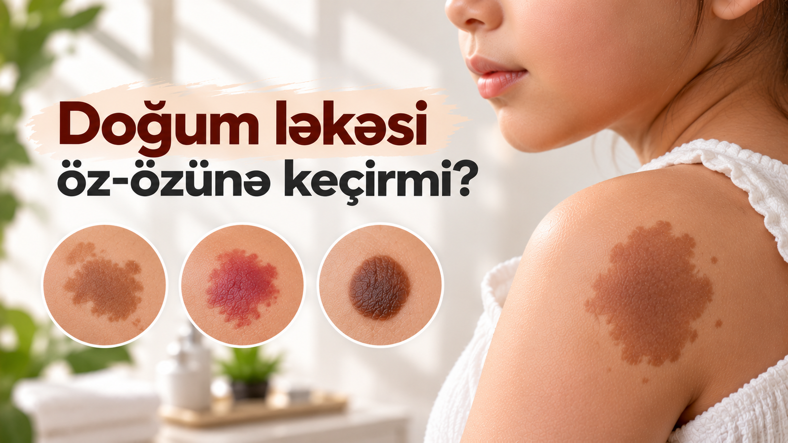 Doğum ləkəsi öz-özünə keçirmi